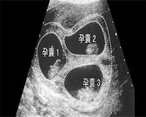 冻胚移植前黄金期的科学调养：HRT激素调节的依据